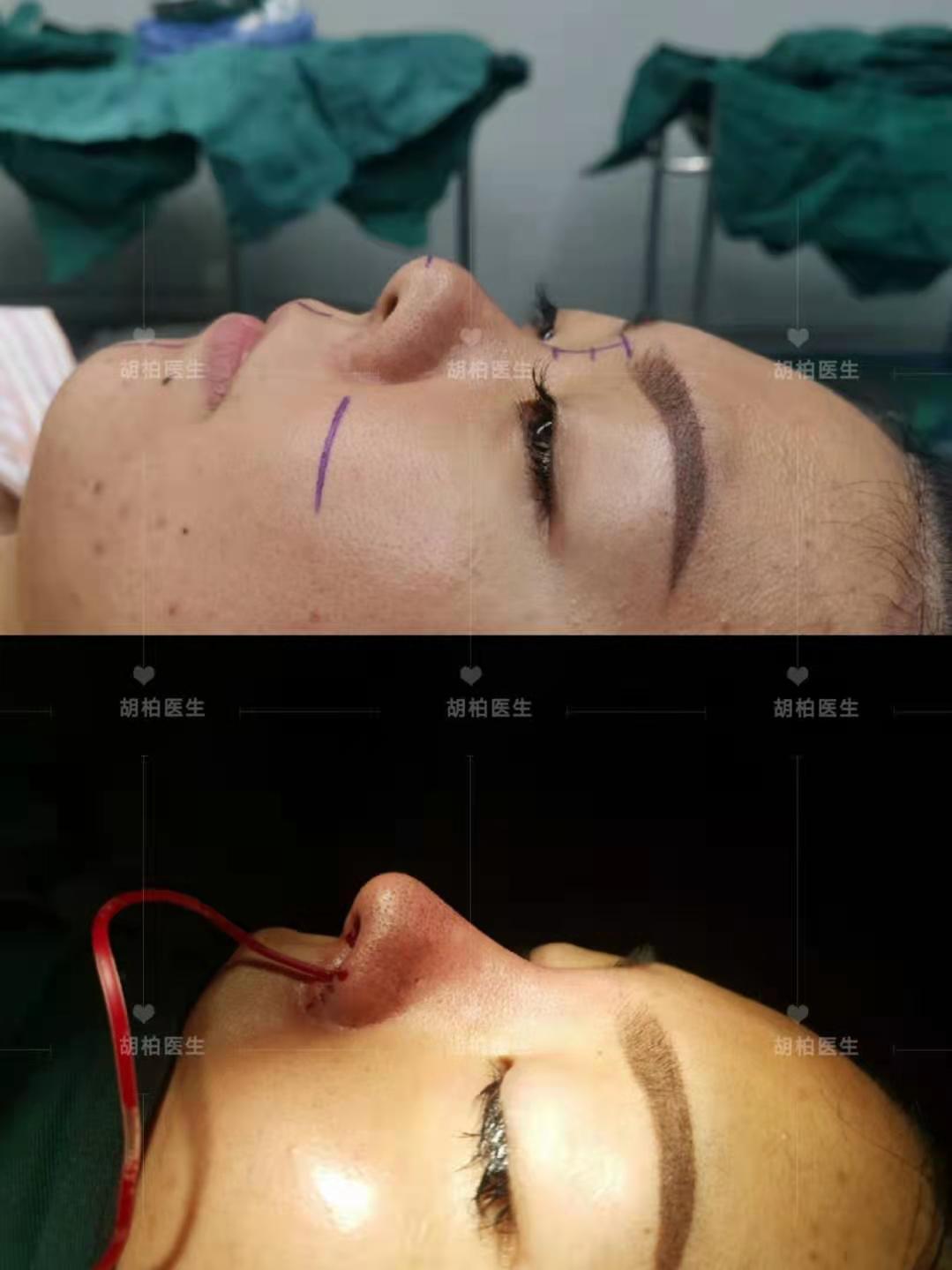 胡柏鼻修复专家解析鼻部修复手术常见的问题